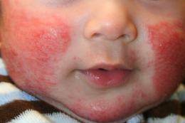 बच्चों-की-त्वचा-पे-एक्जीमा-का-घरेलु-इलाज